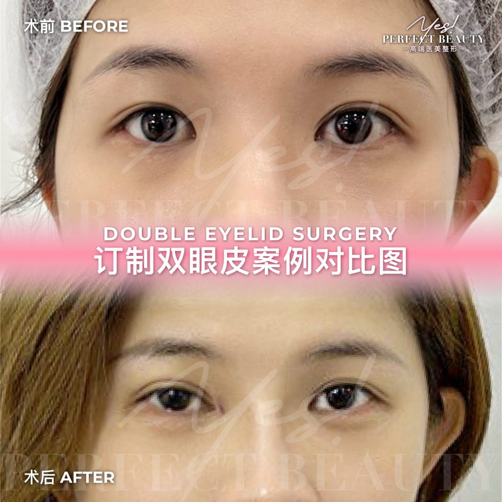 eyelid-01
