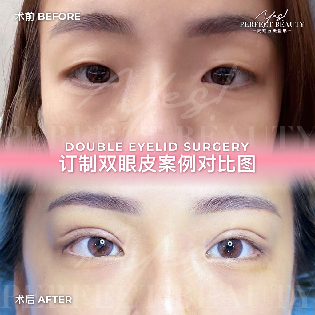 eyelid-02