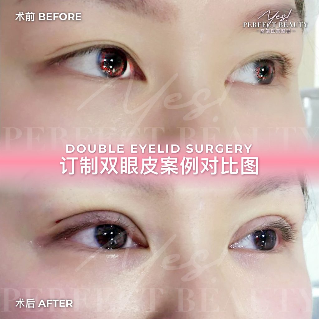 eyelid-03