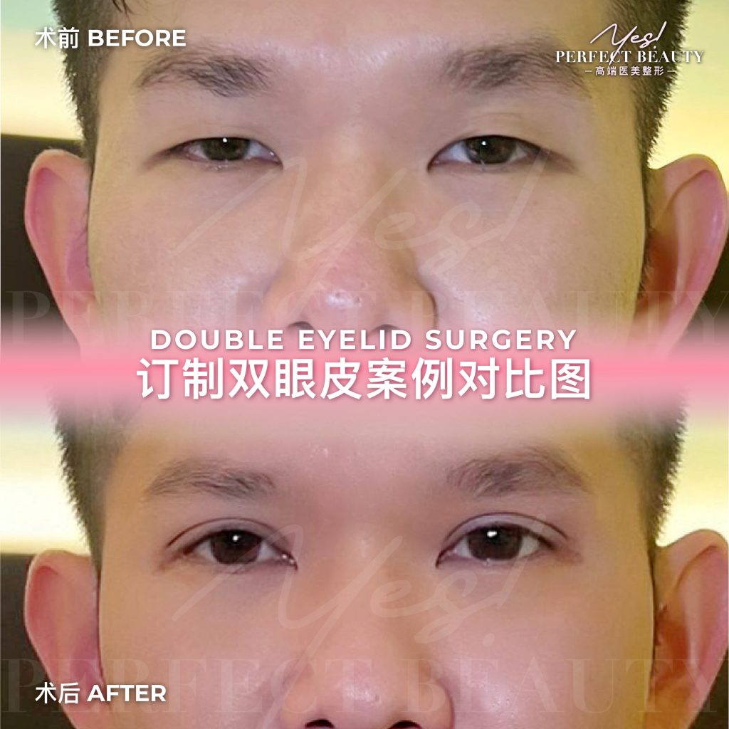 eyelid-04