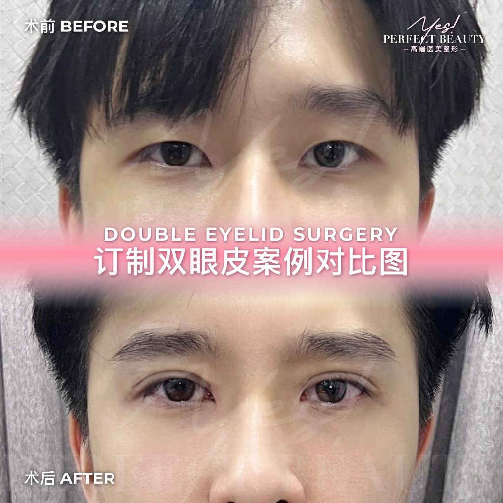 eyelid-06