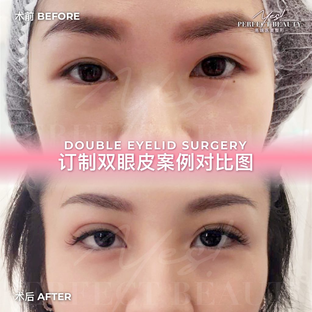 eyelid-07