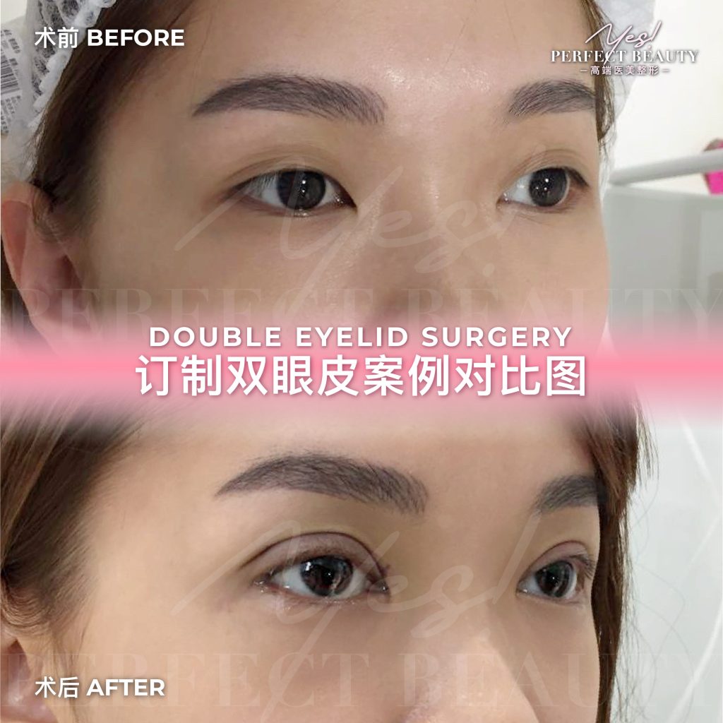 eyelid-08
