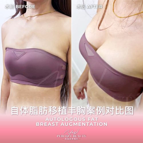 breast-03
