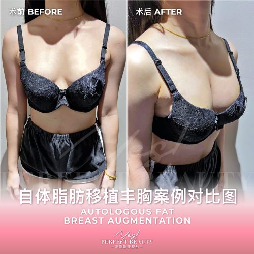 breast-04