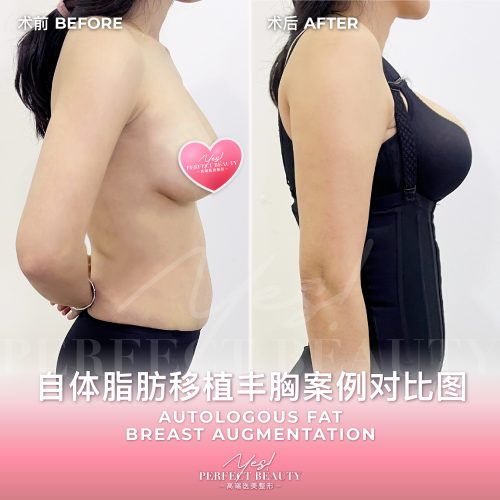 breast-05
