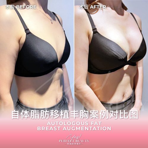 breast-06