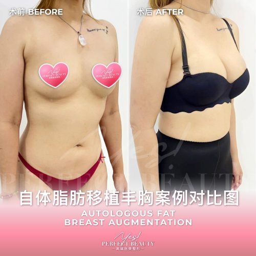 breast-07
