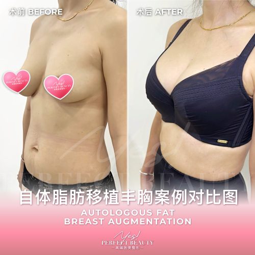 breast-08