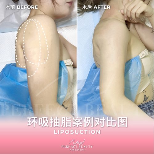 lipo-01