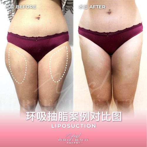lipo-05